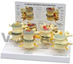 Four Stage Lumbar Vertebrae Set